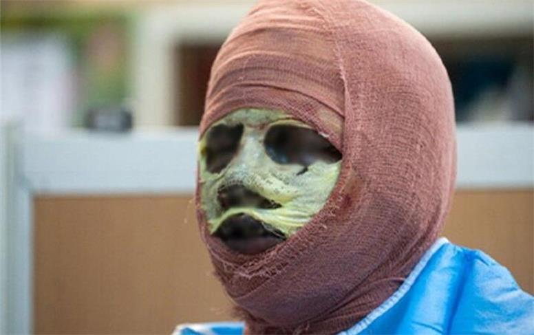 آمار هولناک سوختگی در ایران