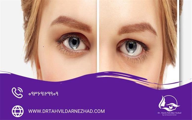 عوارض بلفاروپلاستی؛ چه خطراتی طبیعی و کدام هشداردهنده‌اند؟