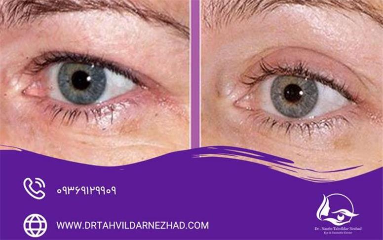روش‌ های نوین و کم‌ تهاجمی بلفاروپلاستی برای پلک بالا و پایین | کاهش تورم و دوره نقاهت