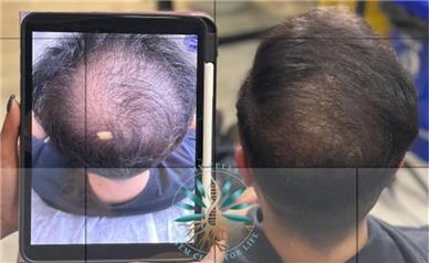 درمان ریزش مو در مشهد؛ راهکاری نوین برای بازگشت تراکم طبیعی مو